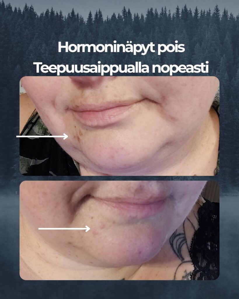 Hormoninäpyt pois Teepuusaippualla nopeasti