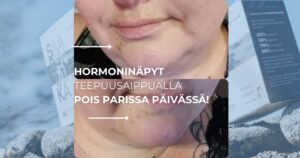 Hormoninäpyt teepuusaippualla pois parissa päivässä!
