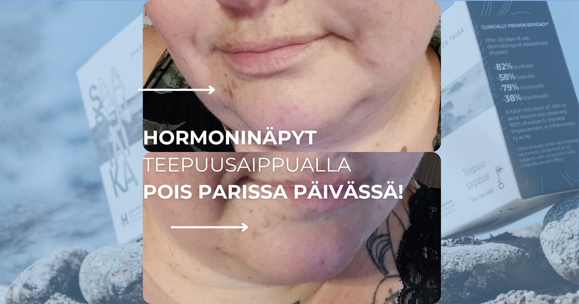 Hormoninäpyt teepuusaippualla pois parissa päivässä!