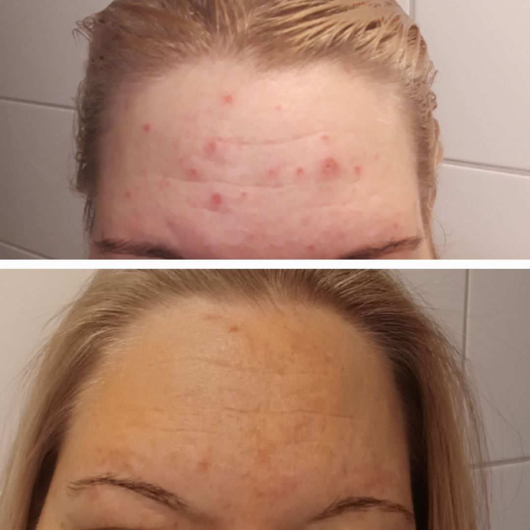 Tässä oma tarinani teepuusaippuasta. Kiitos kun olette olemassa 🙏 Minulla on ollut teini-iästä lähtien akneiho. Ehkäisypillerien lopetus laukaisi myös aikuisiän aknen. Vuonna 2010 söin ensimmäisen isotretinoin kuurini joka paransi aknen. Akne uusiutui vuonna 2019 jolloin kuuri oli uusittava. Apu ei kuitenkaan kestänyt kauaa. En halunnut enää sitä vahvaa kuuria ja kokeilin teidän teepuusaippuaa. Kuvassa ylhäällä lähtötilanne ja ensimmäiset tulokset näkyivät jo 2 viikon kohdalla. Sen jälkeen akne on pysynyt poissa ja ollut rauhallinen. Minulla kestää 1 palasaippua vuoden. Nyt alkaa olla toinen saippua jo lopuillaan. Meinasin seuraavaksi kokeilla aktiivihiili teepuusaippuaa. Kuvassa alhaalla tänään otettu kuva otsastani