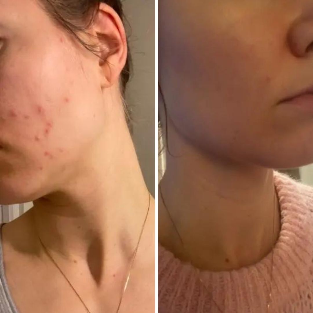 Taikasaippua! Tässä saippuassa on taikaa! Olen kokeillut 20 vuoden aikana lähes kaikkea ruokavaliosta kalliisiin kasvonhoitotuotteisiin akneni hoitoon. Sitten sen paransi muutamassa viikossa saippua! Aivan uskomatonta, kuvat kertokoon puolestaan! Olen hehkuttanut näitä tuotteita nyt kaikille tutuille, olen niiiiin vakuuttunut näiden tehosta!