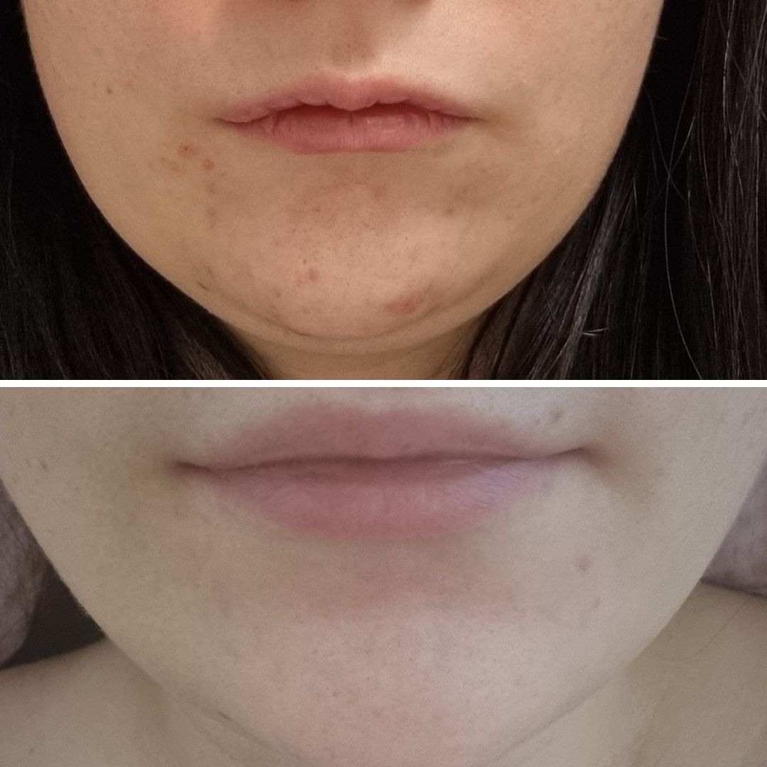 Jestas mikä muutos alin kuva tällä hetkellä ylin ennen Teepuusaippuaa! Kaikki finniarvet joista kärsin kaksivuotta ja uusiutuvat finnit ovat poissa! Pesen kolmenpäivän välein kasvoni teepuusaippualla nykyisin enää ylläpitääkseni tulosta. Ensimmäiset erot näkyivät jo yhden viikon käytön jälkeen ja tämä on tulos 6kk käytöllä, kaikki on poissa, kiitos!!