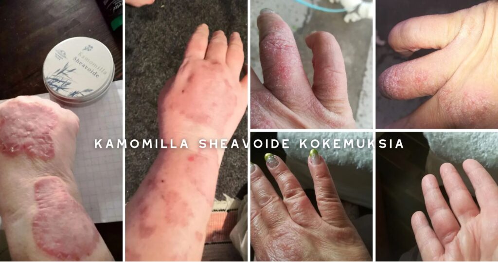 Kamomilla sheavoide kokemuksia
