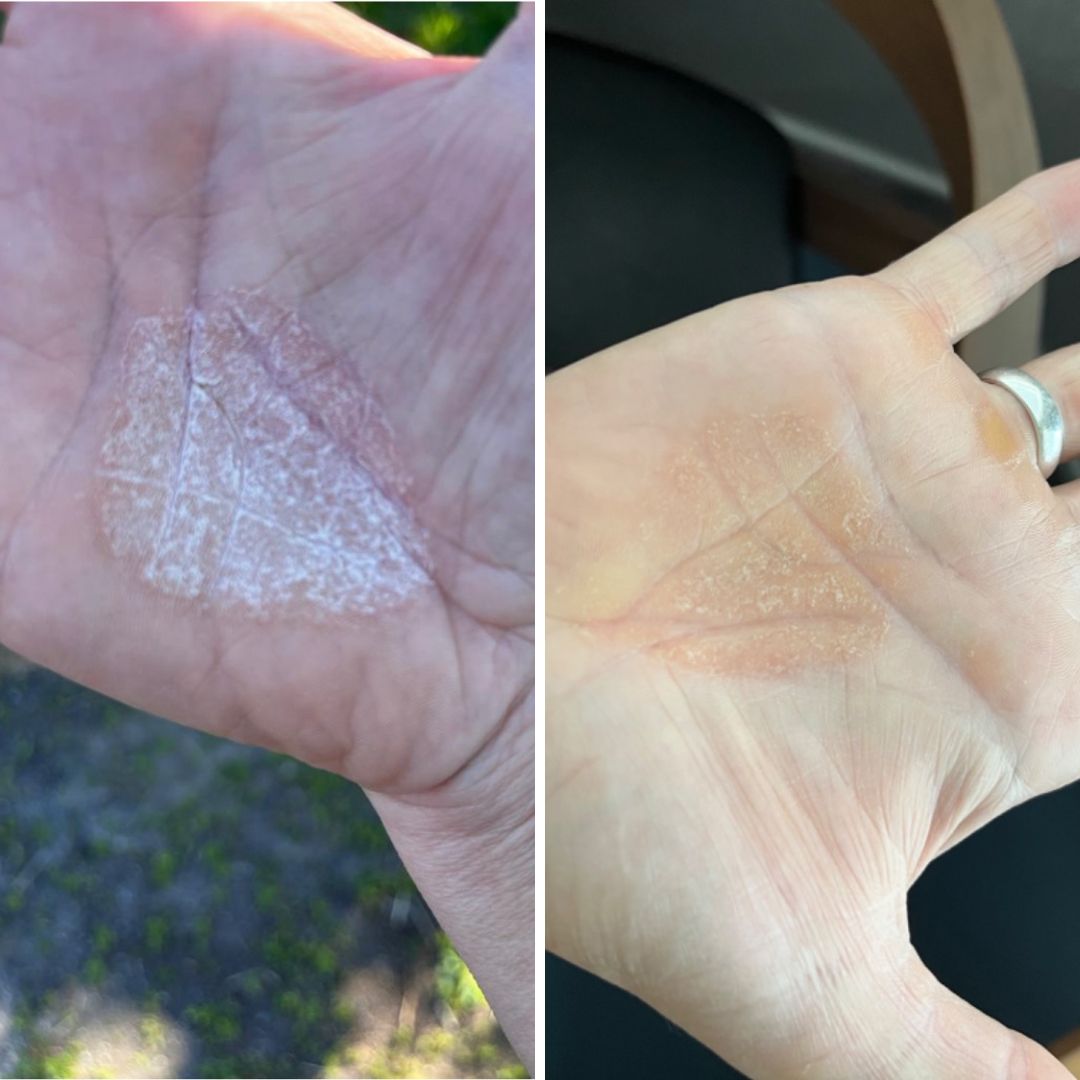 Minulla kutiava ihottuma kämmenessä joka ei ole edes lääkärin ohjeiden mukaan parantunut. Kokeilin Saaren Taika Kamomilla sheavoidetta ja jo viikon jälkeen huomaan että ihottuma on melkein hävinnyt. Voide on hyvä koska se ei jätä ihoa rasvaiseksi, vaan se imeytyy nopeasti.