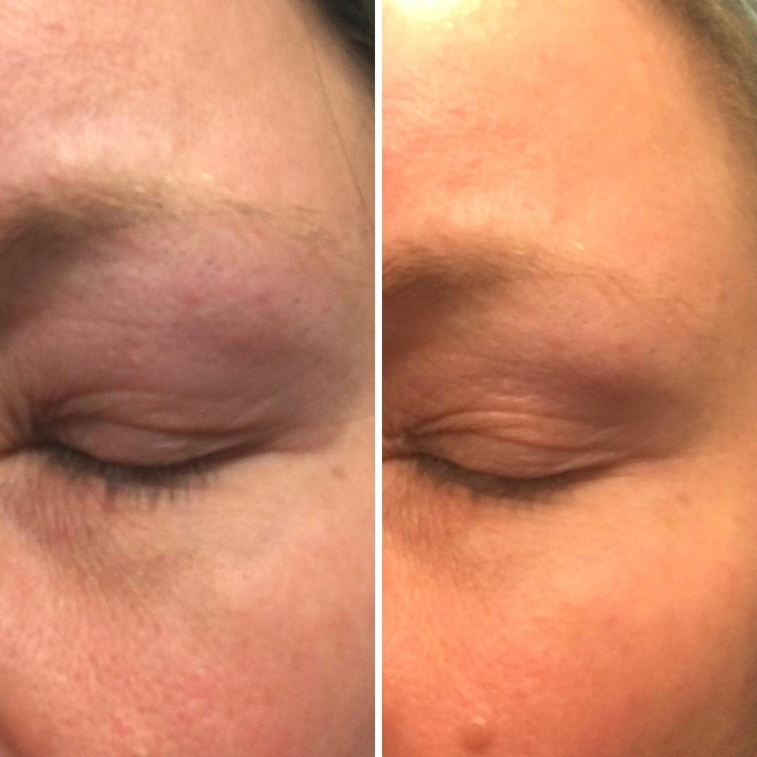 Täytyy sanoa, että on ihan älyttömän tehokas tuo Kamomilla Sheavoide. Eilen illalla ötökät kuppas silmän mustaksi, aamulla laitoin Kamomilla Sheavoidetta (siis yhden kerran vain) ja nyt illalla otin uuden kuvan. Ennenki on näin käynyt ja ei ole semmosta voidetta ollut mikä olis päivässä parantanut ihon. Olen atoopikko ja tähän mennessä käyttänyt aina kortisonia vaivaan kuin vaivaan. Enpä taida käyttää enää. Mahtavaa!!!