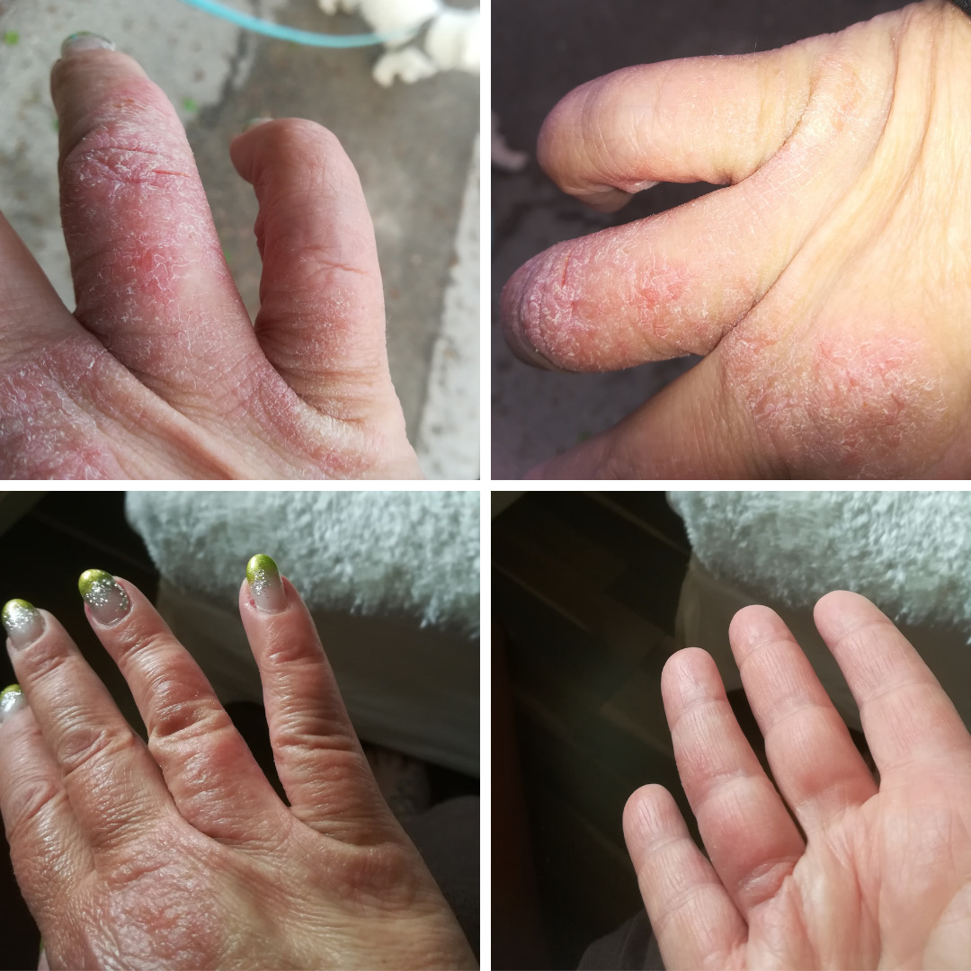 Käsi-ihottuma, 2 päivää Saaren Taika Kamomilla Sheavoidetta käytetty