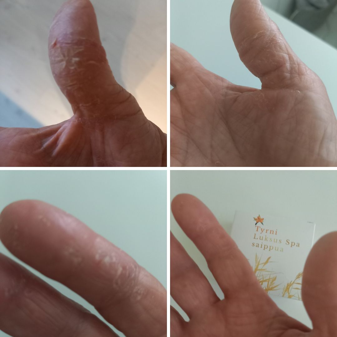 Olen enemmän kuin kiitollinen kun olen löytänyt Tyrni Luxus Spa saippuan ja Kamomilla Sheavoiteen. Olen vuosien ajan taistellut halkeilevien sormenpäiden ja käsien vuoksi. Kortisoni + kaikki mahdolliset apteekin voiteet on ollut kokeilussa. Kymmeniä purkkeja. Näillä kahdella tuotteella käteni ovat aivan ehjät ja terveet. Aikaisemmin olen saanut käteeni useita ruusuinfektioita kun sormen haavasta on päässyt bakteeri vereen ( johtuen huonosta immuunipuolustuksesta toisessa kädessäni). Näiden tuotteiden ansiosta pääsin eroon estolääkityksestä ruusun suhteen. Kiitos Saaren Taika!