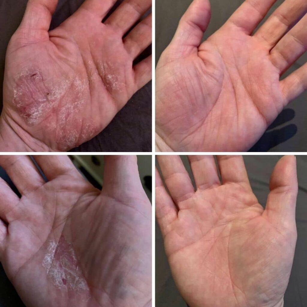 Olen kärsinyt käsi-ihottumasta viimeiset kolme vuotta. Ihotautilääkärit eivät ole löytäneet siihen syytä, eikä apua. Epäilivät liittyvän käsidesin, kosteuden ja suojakäsineiden yhdistelmään. On kokeiltu monia voiteita, perusvoiteista kortisoneihin, mutta mikään ei ole tehonnut. Näin Kamomilla sheavoiteesta mainoksen Facebookissa ja arvosteluja luettuani ajattelin, että syteen tai saveen. Olen käyttänyt voidetta nyt nelisen viikkoa ja se oikeasti toimii. En voisi enää tyytyväisempi olla! Kuvat puhukoot puolestani.