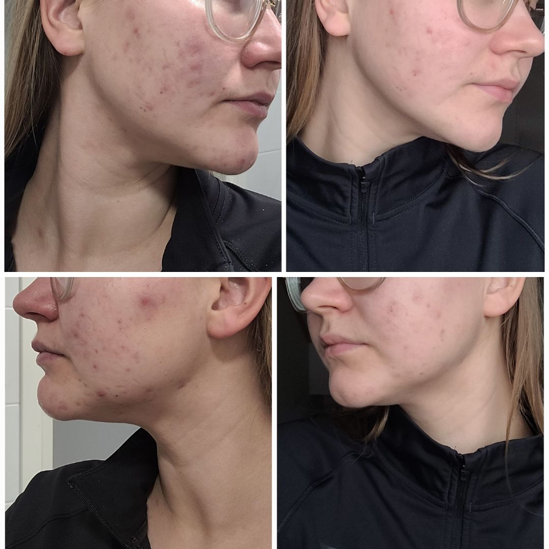 Olen niin onnellinen, että löysin teidän teepuu-saippuan ja hyalyronihappo+hedelmäseerumin. Poskissa ja leukapielissä oleva kipeä akne on parantunut huimasti. Sen lisäksi iho ei enää kutise ja kuivu ja on muutenkin tasoittunut esimerkiksi lapsena kerätyt arvet ei enää pomppaa silmille. Iho myös hehkuu. Olin toimitsijana salibandypelissä ja mun toimitsijapari kesken pelin kysy: "Mitä sä käytät, kun sun iho näyttää noin hyvältä ja puhtaalta?". Yllätyin täysin, että voiko se näkyä ja näkyyhän se. On kyllä saanut suositella eteenpäin näitä tuotteita, niin tyytyväinen olen.