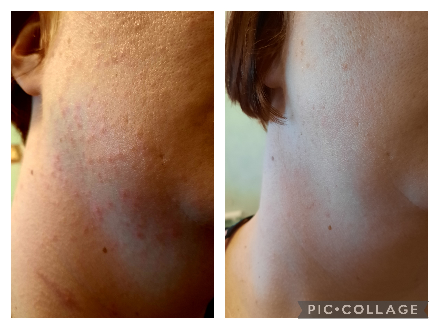 Viime viikon lauantaina 4.6. minulle puhkesi ruusufinni. Minulla sattui olemaan teidän Teepuusaippuaa ja aloin pesemään kasvoni sillä päivittäin. Liitteessä toinen kuva tältä päivältä 10.6 ja huomaatte mikä ero. Huippu tuote.