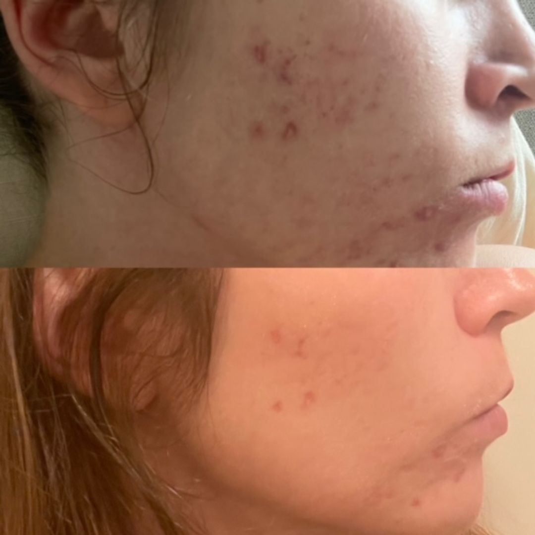 Heippa! Olen käyttänyt jo useamman vuoden apteekista saatavia tuotteita, joita suositellaan akneiholle. Somesta löysin näitä muutoskuvia, joita ihmiset ovat lähettäneet käytettyään Saaren Taika -tuotteita. Päätin kokeilla itsekin. Olen käyttänyt nyt yhden kuukauden Saaren Taika Teepuusaippuaa sekä Salisyylihappo puhdistusmaitoa. Ja muutos on mieletön. Vuosien muiden tuotteiden käytön jälkeen muutos ei ole koskaan ollut tällainen. Olen käyttänyt jo useamman vuoden apteekista saatavia tuotteita, joita suositellaan akneiholle. Somesta löysin näitä muutoskuvia, joita ihmiset ovat lähettäneet käytettyään Saaren Taika -tuotteita. Päätin kokeilla itsekin. Olen käyttänyt nyt yhden kuukauden Saaren Taika Teepuusaippuaa sekä Salisyylihappo puhdistusmaitoa. Ja muutos on mieletön. Vuosien muiden tuotteiden käytön jälkeen muutos ei ole koskaan ollut tällainen.