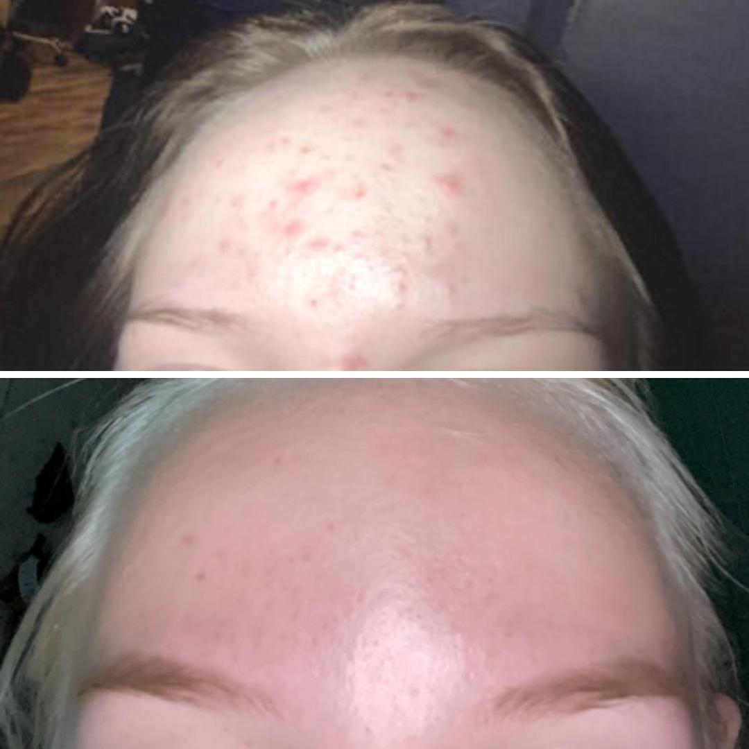 Minulla on ollut paha akne johon sain lääkkeet, ostin hoitoa tehostamaan Teepuusaippuan ja se on auttanut todella paljon! Nytkin akne kuurin loputtua olen tuotteen käyttämistä jatkanut ja ei ole tullut mitään iho ongelmia enään kasvojen alueelle. Koen että Saaren Taika Teepuusaippua on yksi suurista syistä minkä takia akneni hävisi.