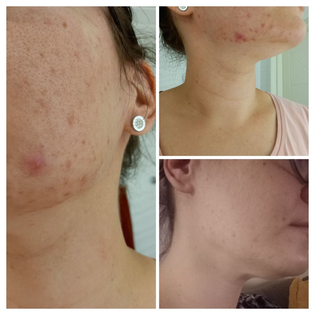 Olen kärsinyt aikuis-iän aknesta, vaikka luulin aknen jäävän teinivuosien mukana taaksepäin. Lisäksi minulla on kovin herkkä ja pintakuiva iho. Teepuusaippua on ollut pelastus kasvojeni iholle. Olen pessyt kasvot iltaisin Teepuusaippualla, (käytössä ollut sekä nestemäinen että palasaippua, palasaippua minun lemppari). Iho parantunut huomattavasti. Vanhoja arpia toki on, mutta ihoni on paremmassa kunnossa kuin aikoihin. Uusia finnejä tulee todella vähän ja jos tulee niin ihan yksittäisiä vain jotka nopeasti kuivuvat saippuan käytöllä pois. Kiitos, olen saanut kasvoni takaisin!