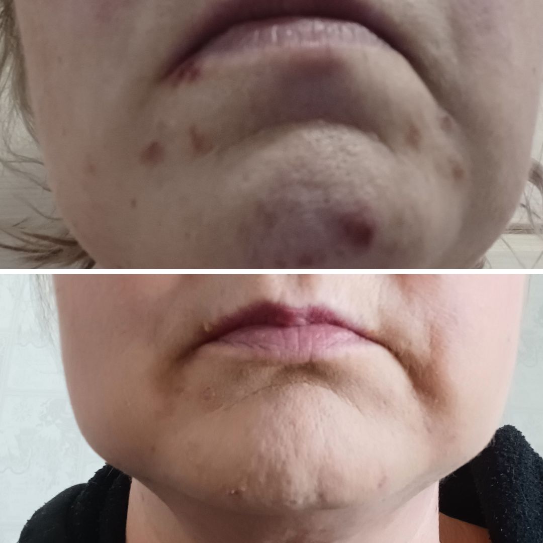 En ole 42 vuoden ikään mennessä kärsinyt iho-ongelmista. Yhtäkkiä alkoi leukaan ilmestymään näppyjä joita vaan tuli ja tuli. Olin hetken jo täysin lamaantunut, kun joka aamu ja ilta ilmestyi uusi näppylä ja leuka näytti hirveältä. Rupesin joka aamu ja ilta pesemään kasvoni Teepuusaippualla ja pikkuhiljaa näpyt alkoivat häviämään eikä lisää enää ilmestynyt. Ensimmäinen kuva otettu 17.2 ja toinen tänään 15.3. Ero on huomattava ja ihoni on jälleen terve!