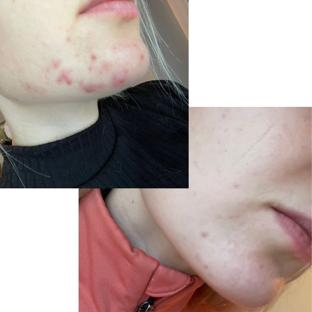 Hei, Kuvista näkee mitä Saarentaika Teepuusaippua sai aikaan vähän päälle kuukauden käytön jälkeen! Iho meni huonoon kuntoon kun korona alkoi ja kasvomaskin käyttö. Työni puolesta joudun edelleen käyttämään maskia päivittäin, mutta iho ja kipeät näpyt on rauhoittuneet. Kannatti kokeilla!