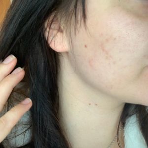 Saaren Taika teepuusaippua kokemuksia