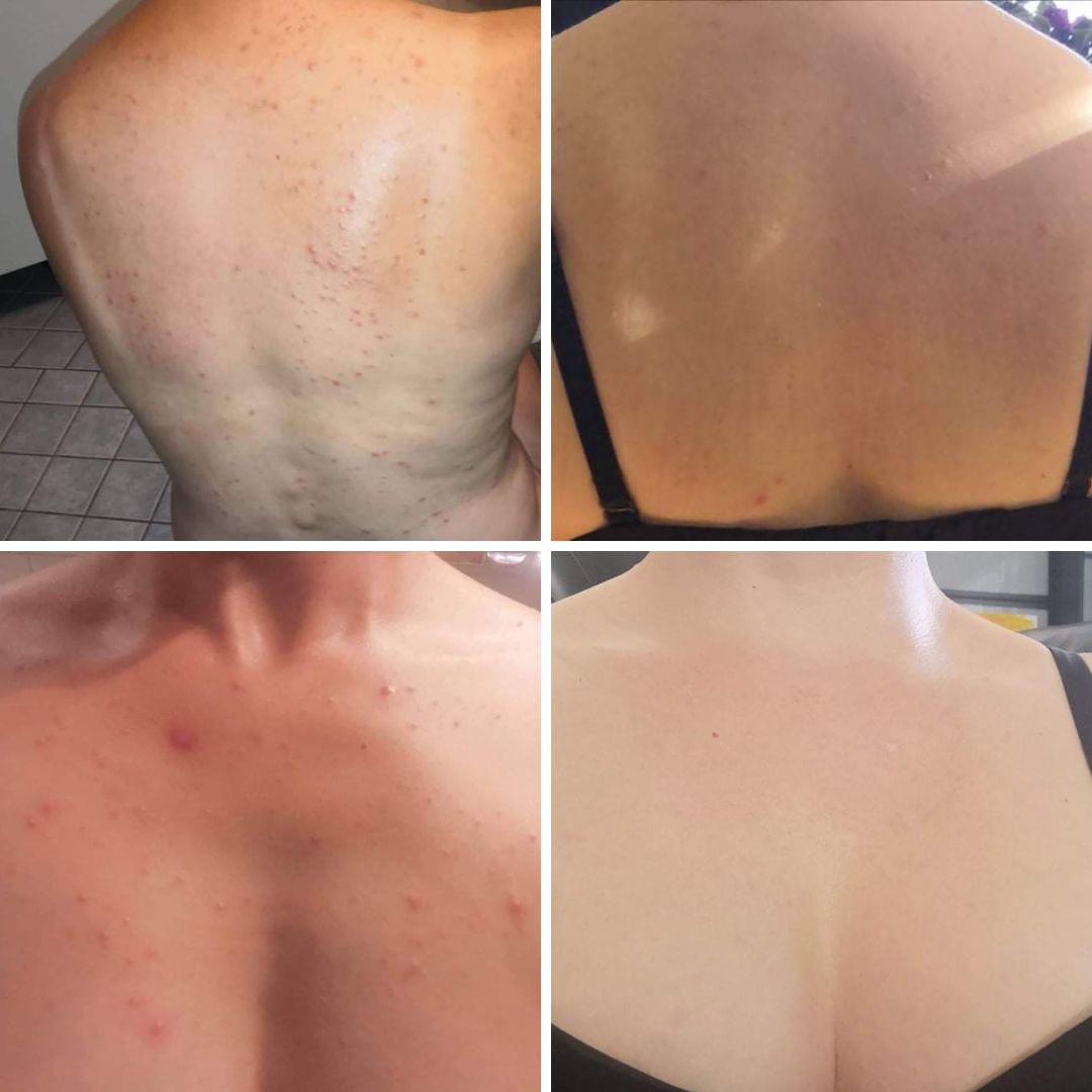 Olen kärsinyt aina hormonaalisesta aknesta, selässä enimmäkseen. Kesäisin myös dekolteen alueella. Kauhulla aina odotan tulevia kesiä ja juhlia kun iho on mitä on eikä mikään ole auttanut. Olen saanut eri lääkekuureja, ostanut voiteita, ollut syömättä sitä sun tätä. Koko netti selannut läpi löytämättä kuitenkaan toimivaa konstia tähän niin kiusalliseen ongelmaan. Tänä keväänä ostin Saaren Taika Teepuusaippuan ja ajattelin että koitanpa nyt kun sitä niin kehutaan. Tämä muutos vaati jokapäiväisessä käytössä, yhden saippuan. Alkukesästä aloitin käytön ja nyt on iho todella hyvä. Kiitos Saaren Taika että voin taas käyttää toppeja ja käydä uimassa." -42-vuotias, 3 lapsen äiti.