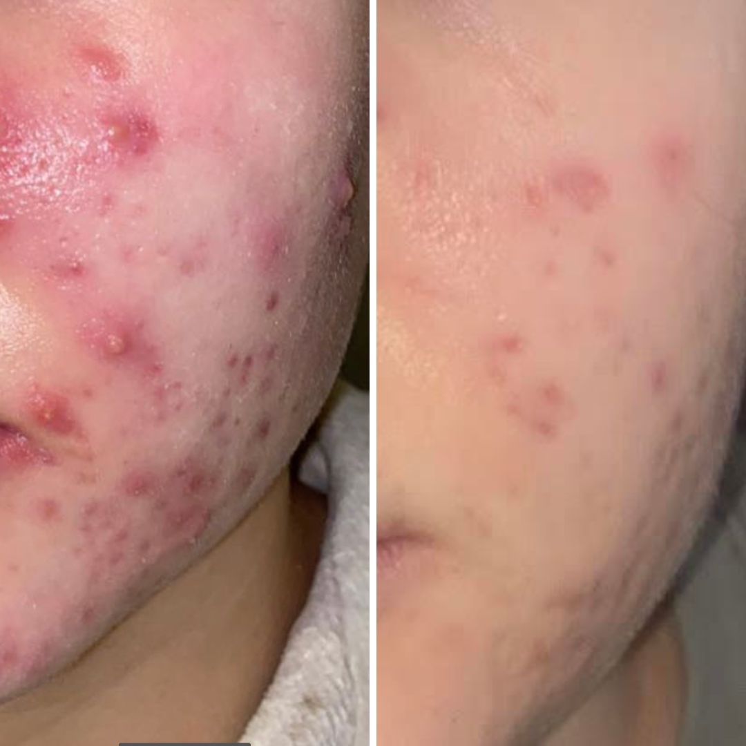 Hei! Olen käyttänyt Saaren taika Teepuusaippuaa kohta kuukauden ja olen erittäin tyytyväinen tähän tuotteeseen, sillä se on auttanut akneen todella hyvin. Mikään muu tuote ei ole auttanut. Kiitos tästä mahtavasta tuotteesta!