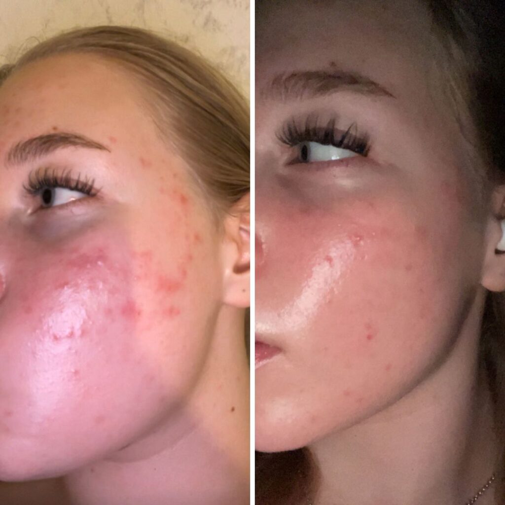 Moikka, oon kohta pari kuukautta käyttänyt Saaren Taika Teepuusaippuaa (palasaippua), Ruusu-Aloe kasvovettä ja Kamomilla Sheavoidetta sekä Aktiivihiili & Savi kasvonaamiota. Oon jo monta vuotta taistellut kasvojen epäpuhtauksien kanssa ja käyttänyt monia satoja euroja ihonhoitotuotteisiin jotka eivät ole edes auttaneet. Sitten tuli somessa vastaan teidän mainos ja päätin kokeilla, olen ollut hyvin tyytyväinen tuloksiin enkä tosiaan ole vaihtamassa näitä tuotteita enää pois. Aivan upeaa!! Ohessa ennen ja jälkeen kuvat (noin kuukausi mennyt tuossa)