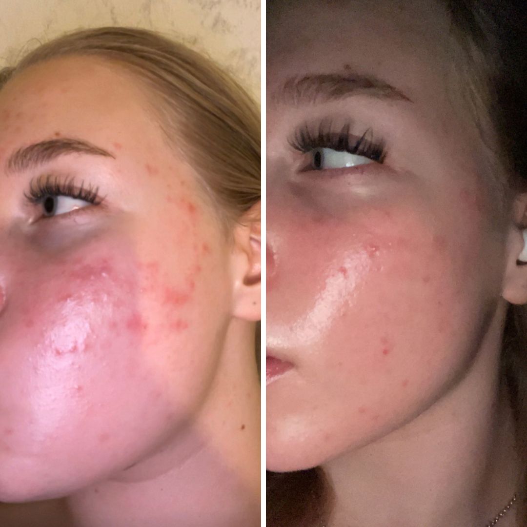 Moikka, oon kohta pari kuukautta käyttänyt Saaren Taika Teepuusaippuaa (palasaippua), Ruusu-Aloe kasvovettä ja Kamomilla Sheavoidetta sekä Aktiivihiili & Savi kasvonaamiota. Oon jo monta vuotta taistellut kasvojen epäpuhtauksien kanssa ja käyttänyt monia satoja euroja ihonhoitotuotteisiin jotka eivät ole edes auttaneet. Sitten tuli somessa vastaan teidän mainos ja päätin kokeilla, olen ollut hyvin tyytyväinen tuloksiin enkä tosiaan ole vaihtamassa näitä tuotteita enää pois. Aivan upeaa!! Ohessa ennen ja jälkeen kuvat (noin kuukausi mennyt tuossa)