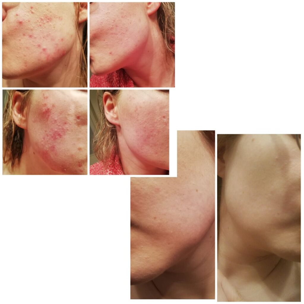 Olen pitkään aikonut laittaa palautetta tulemaan teepuusaippuasta, mutta se on vaan aina jäänyt antamatta. Nyt haluaisin kuitenkin kiittää aivan huipputuotteesta, joka auttoi minua selättämään pahan aknen. :) Vuonna 2020 minulle alkoi tulemaan tosi kipeitä ja isoja ihonalaisia näppylöitä poskien alueelle. Samaan aikaan jouduin pitämään töissä maskia koko ajan ja se vain pahensi aknea päivä toisensa jälkeen. Jossain vaiheessa ihon tulehduskierre meni vain pahemmaksi ja jopa nukkuminen alkoi olla inhottavaa kun iho oli niin kipeä. Jopa ihon peseminen sattui paljon. Koetin monenlaista apteekkituotetta ja kävin myös ihotautilääkärillä. En kuitenkaan voinut aloittaa lääkekuuria akneen, joten itsehoito oli ainoa vaihtoehto. Iho tuntui menevän vain pahemmaksi ja mikään ei tuonut helpotusta. Päätin vielä kuitenkin koettaa teepuusaippuaa kun olin kuullut siitä pari hyvää kokemusta tuttavilta. Ensimmäinen kuva on otettu noin viikon käytön jälkeen. Iho oli todella punainen ja täynnä kipeitä näppyjä. Ensimmäisen parin viikon aikana tuntui että ei tästäkään taida olla apua, mutta kun kuukausi oli mennyt olin jo huomannut, ettei uusia näppyjä ole ilmaantunut enää. Olin kuitenkin edelleen hieman skeptinen, koska ajattelin, ettei hormonaaliseen akneen voi saada apua saippualla. Seuraava kuva on otettu n. 4 kk käytön aloittamisesta ja ero on aivan käsittämätön! En osannut kyllä odottaa tuotteen olevan noin tehokas! Tämän jälkeen iho on vain parantunut entisestään ja nykytilanne on todella hyvä (kolmas kuva). Tosi monet ystävät ja sukulaiset ovatkin kyselleet, että miten olen saanutkin ihon niin hyvään kuntoon. Näin hyvässä kunnossa ihoni on tuskin ollut ikinä, koska olen koko ikäni kärsinyt jonkinlaisista iho-ongelmista. Mainostan kyllä kaikille mielelläni ihoni salaisuutta. :D Kiitos vielä tuhannesti upeasta tuotteesta! En enää halua vaihtaa mihinkään muuhun. :)