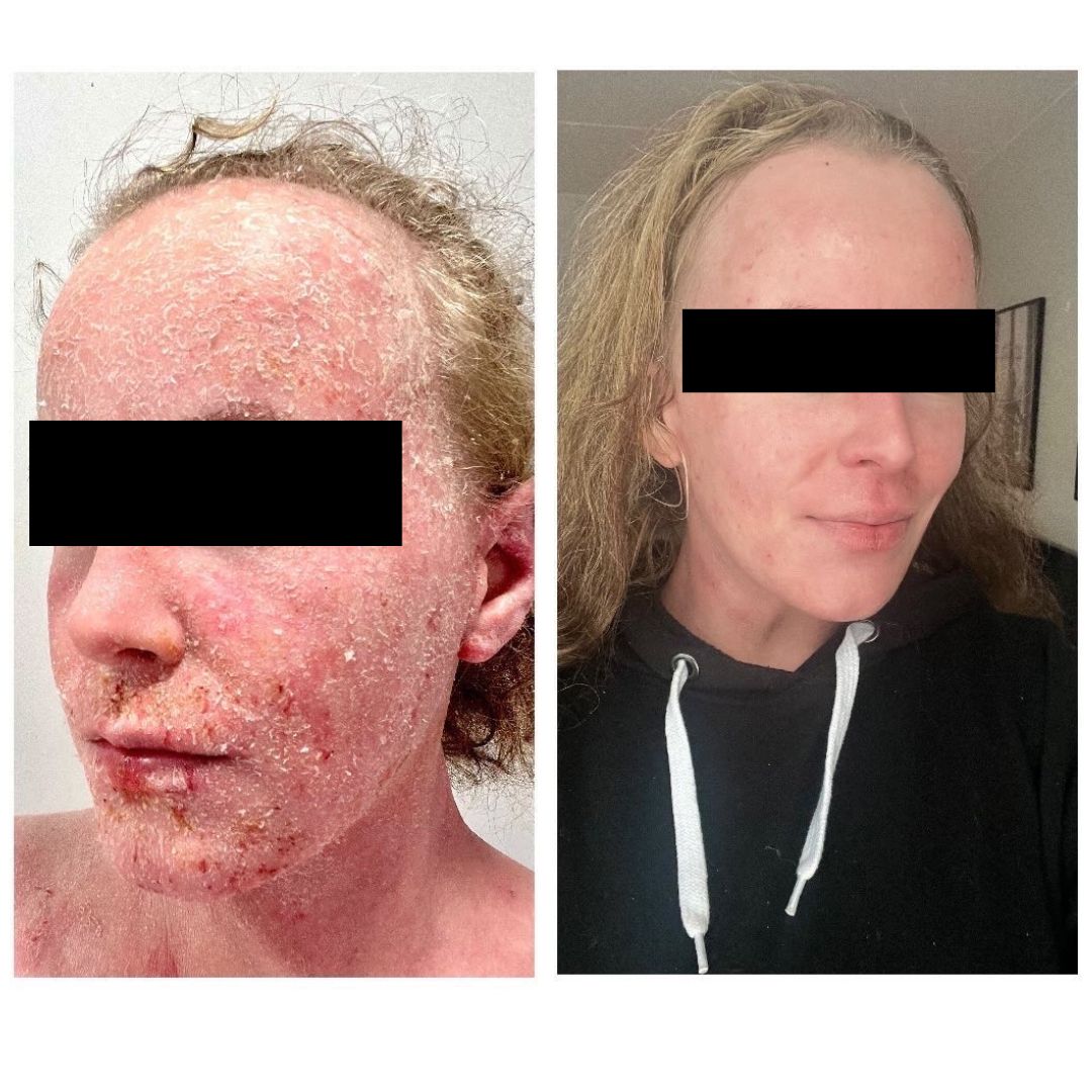 Olen hieman reilu vuoden sairastanut vaikeaa atooppista ekseemaa ja iholle on vuoden aikana läträtty suuret määrät kortisoni ja muita lääkevoiteita, jotka ovat pahentaneet tilannettani ennestään. Nyt olen hoitanut ihoani useamman kuukauden luonnollisesti ja lääkkeettä. Viimeisimpänä testissä ovat olleet Saaren Taian ihanat tuotteet, joista olen saanut suuren avun kutinaan ja ihon hilseilyyn. Tuotteiden ansiosta olen saanut kasvot jo hyvään kuntoon. Päivittäis käytössä ovat olleet Saariston suolasaippua, Aloe Vera 24h kosteuttaja ja rauhoittava kamomilla vartalovoide. Parasta on, että nämä tuotteet eivät kirvele ja ne rauhoittavat tehokkaasti kutisevaa ihoa. Suuri suositus.