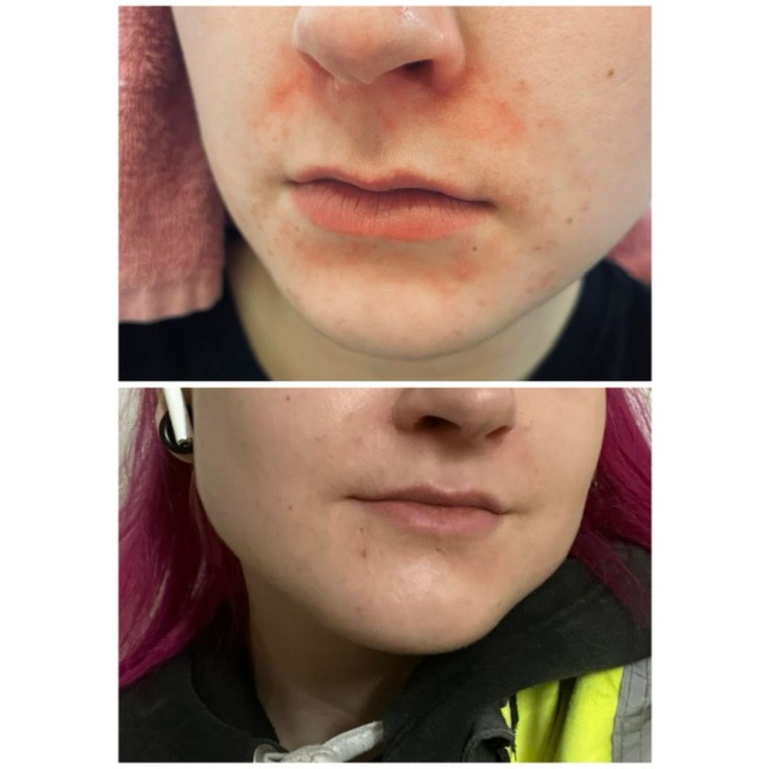 Oon siis käyttänyt teepuusaippuaa ALLE VIIKON, kuukausia taistelin vaikka jos minkä aineiden kanssa että saisin ihon punotuksen ja näppylät kuriin mutta mikään ei auttanut. Sitten onneksi tuli kuin tilauksesta mainos vastaan, tuote oli vielä sopivasti alessa niin aattelin että no mää kokeilen. Heti ekan käyttökerran jälkeen punotus selvästi laski, ja nyt tilanne kasvoilla on jo tosi hyvä. Toki vähän kuiva, mutta hyvin ku kosteuttaa niin ei kyllä mitään valittamista! Toki alkutilannekkaan ei ihan niin paha ole ku joillakin ihmisillä on ollut, mutta tosiaan useat tuotteet testanneena oon kyllä ite erittäin tyytyväinen juurikin tähän tuotteeseen ja aion jatkaa sen käyttöä jotta loputkin näppylät ja punotus häviäis! 😊 Tuotteen käytön aloitin torstaina, ennen-kuva saman viikon sunnuntailta, jälkeen-kuva seuraavan viikon keskiviikolta.