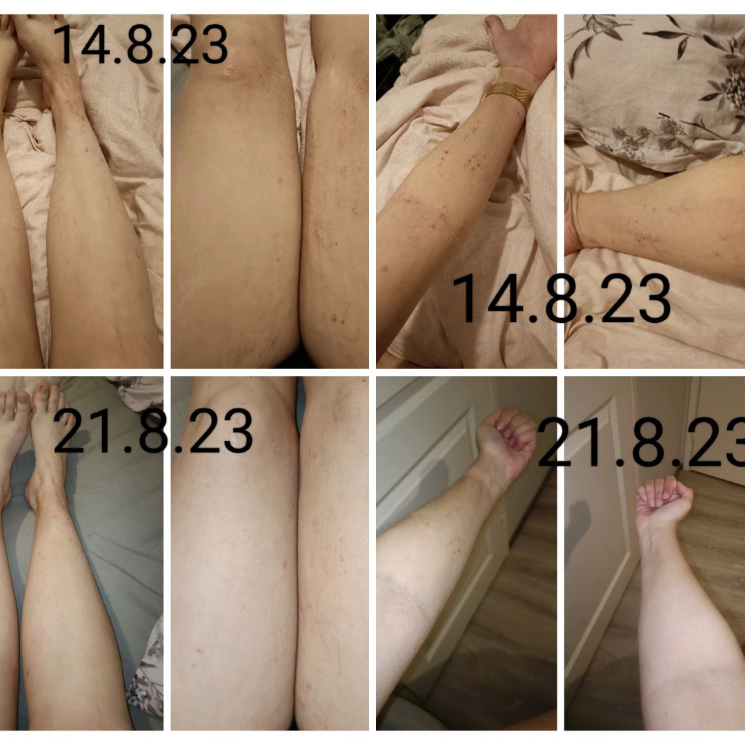 Saaren Taika Teepuusaippua ja Kamomilla Sheavoide atooppisen ihon ongelmaan