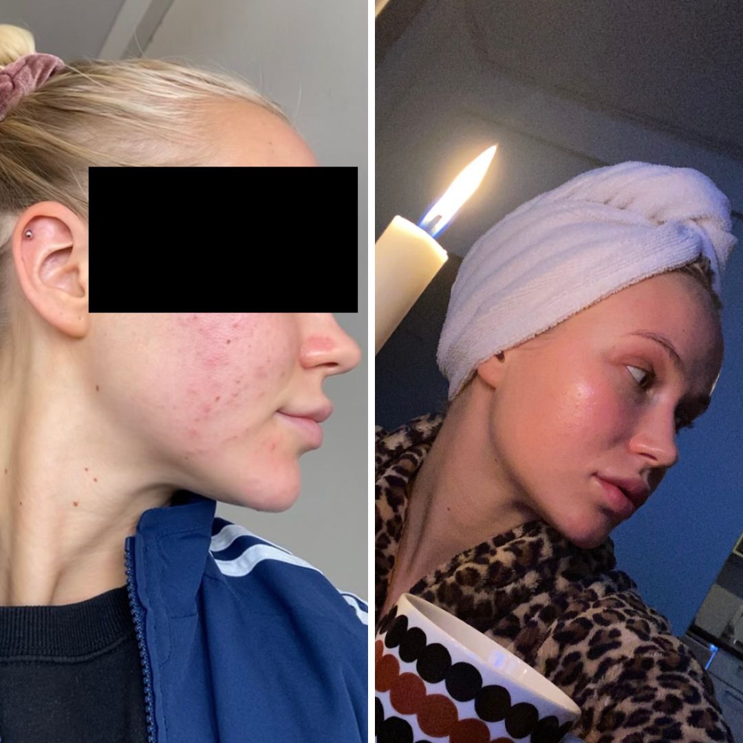 Käytössä teepuusaippua ja hyaluronihappoa sisältävät kasvo- ja silmänympärysvoide. Ihon kunto parani hetkessä.