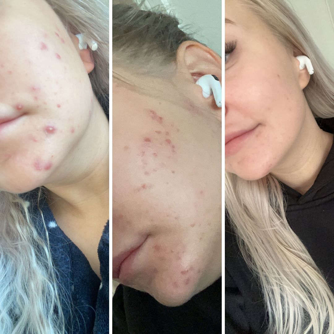 Hei, ennen Saaren Taika Teepuusaippuan ostoa kärsin vuosia pahasta aknesta, lääkekuurit auttoivat vain hetkellisesti ja sivuoireet näistä olivat kamalia. Finnit olivat kipeitä ja itsetuntoni kärsi näistä suuresti. Huomasin saippuan vaikutuksen ihooni jo hyvin nopeasti, nyt ihoni voi hyvin ja arvetkin vanhoista finneistä ovat alkaneet kaikota. Aivan paras tuote, suosittelen ehdottomasti❤️