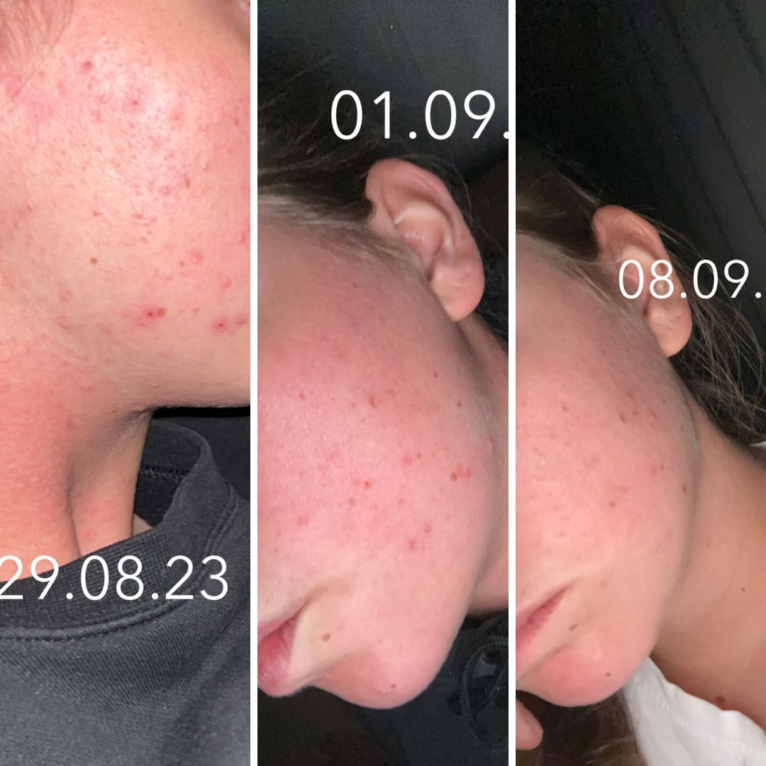 Moikka! Haluaisin lähettää positiivista palautetta! olen jo hetken kamppaillut finneistä ihollani, laitan alas muutaman kuvan joissa on päivämäärät, ihan parissa viikossa olen saanut huiman muutoksen ihooni Saaren Taika Teepuusaippualla. Olen ollut todella tyytyväinen! kiitos!