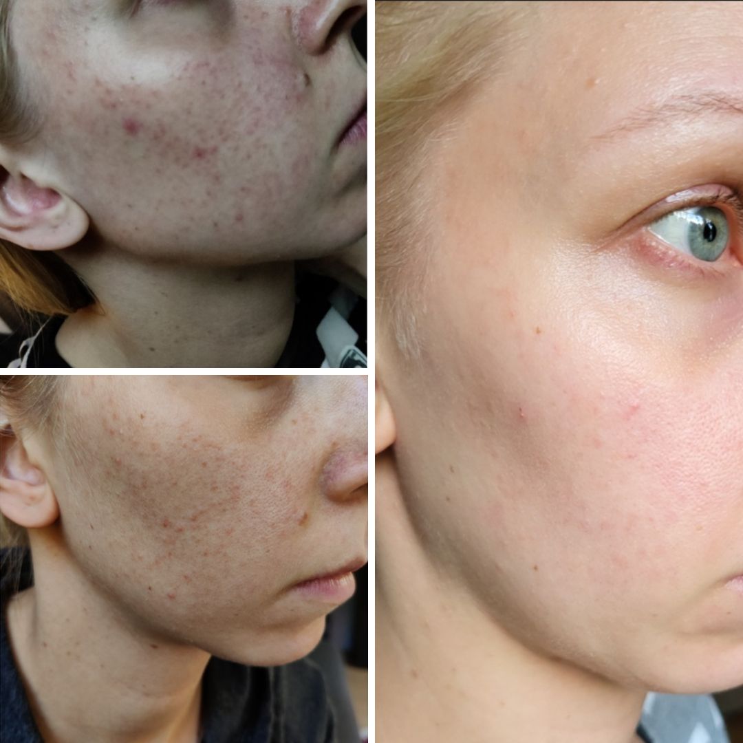 Hei! Ajattelin kiittää teitä tästä ihanasta tuotteesta joka toi avun omaan iho ongelmaani. Kasvojeni Iho "räjähti" kun aloitin työt äitiysloman jälkeen uudessa työssä. Kokeilin monia kaupan ja apteekin tuotteita mutta tuntui, että mikään ei auttanut tai saattoi auttaa vähäksi aikaa kunnes ihoni meni jälleen huonoon kuntoon. Taisin törmätä ensi kertaa kyseiseen tuotteeseen netissä ja pitkän harkinnan ja tutkimisen jälkeen raaskin ostaa Saaren Taika Teepuusaippuan. Kuukausi käytön jälkeen ihoni oli parantunut huomattavasti ja nyt vuoden käytön jälkeen ihoni kunto on pysynyt todella hyvä vaikka en joka päivä saippuaa käytäkkään. Aika ajoin on vain pieniä näppyjä siellä täällä mutta mitään "räjähdystä" ei ole tullut! Kiitos teille oloni on itsevarmempi taas 😍