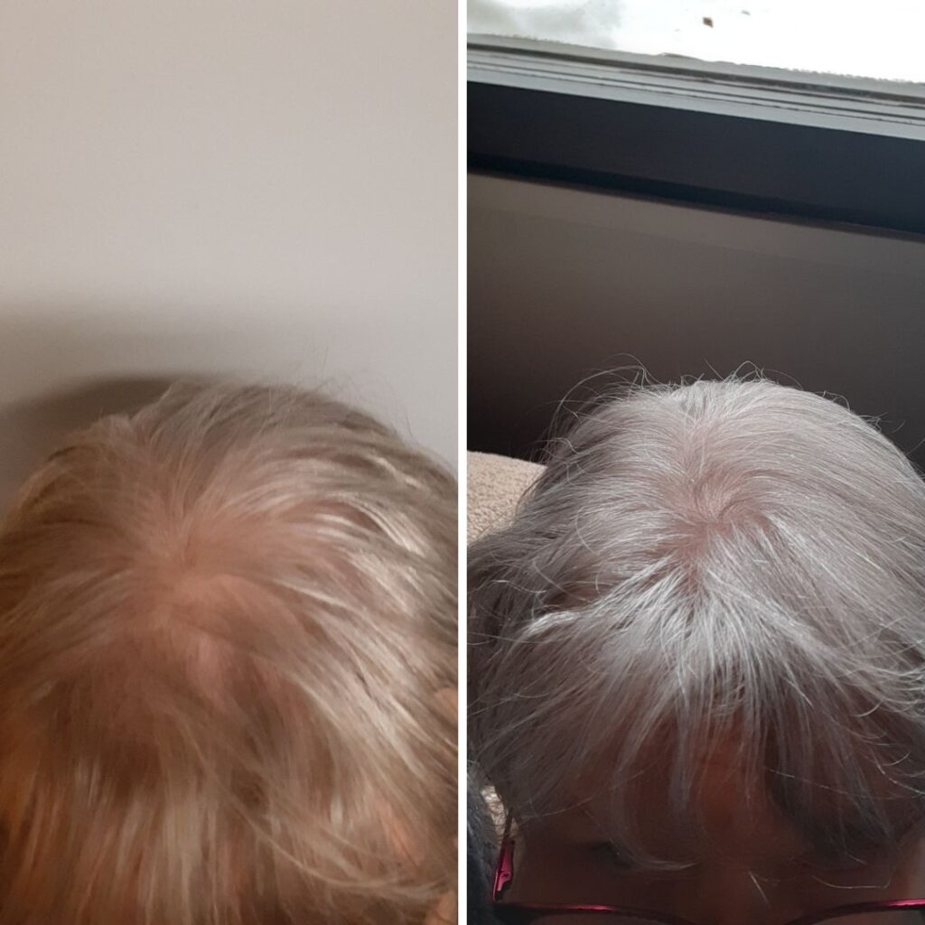 Nyt olen käyttänyt Tyrni kehäkukka shampoota ja hoitoainetta reilut 2 kuukautta. Hiuksiin on palautunut upea kiilto ja hiukset pysyvät pidemmän aikaa rasvoittumatta. Myös hiustenlähtö lähes loppunut sekä hiukset näyttävät vahvistuneet. Olen erittäin tyytyväinen tuotteisiin