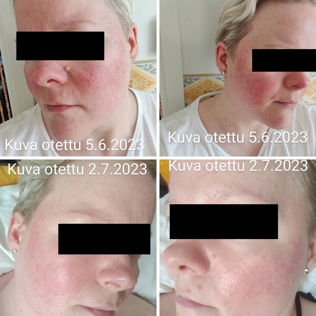 Hei, ostin reilu kk sitten Tyrni Luksus Spa saippuan ja olen todella tyytyväinen siihen. Iho on osin rasvainen, ja talvella etenkin kuiva. Lisäksi on Couperosa ja ruusufinni tullut siihen vielä kiusaksi. Heti ensimmäisten pesujen jälkeen ihon pinta ei ole enään niin kuiva/ kireän oloinen. Ja kiilto on tullut takaisin. Olen juuri täyttänyt 40-v ja ajattelin jo, että kärsin tästä eikä apua ole. Sitten luin tästä Saaren Taika Tyrni Luksus Spa saippuasta ja muiden käyttäjien kokemuksia ja päädyin siihen, vaikka aktiivihiili teepuusaippuakin kuulosti houkuttelevalta (ehkä kokeilen sitäkin vielä), enkä ole katunut. Punoitus on vähentynyt, ja näppyjä ei tule enään niin paljon. Iho ei kutise enään niin juurikaan ja muutenkin se on huomattavasti rauhoittunut. Suuret kiitokset, ja lämmin suositus näihin tuotteisiin minulta.