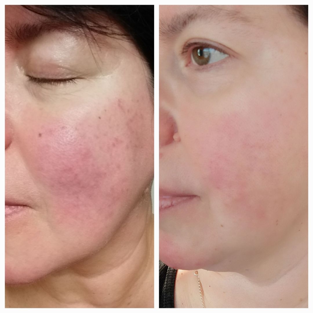 Hei! Halusin kertoa miten paljon olen saanut apua ärtyneen ihoni hoitamiseen. Kuvissa näkyy ero ennen ja jälkeen Saaren Taika tuotteiden Olen käyttänyt nestemäistä teepuusaippuaa, ruusu-aloe kasvovettä sekä Aloe Vera 24h kosteuttajaa ja yöksi rauhoittavaa hoitovoidetta