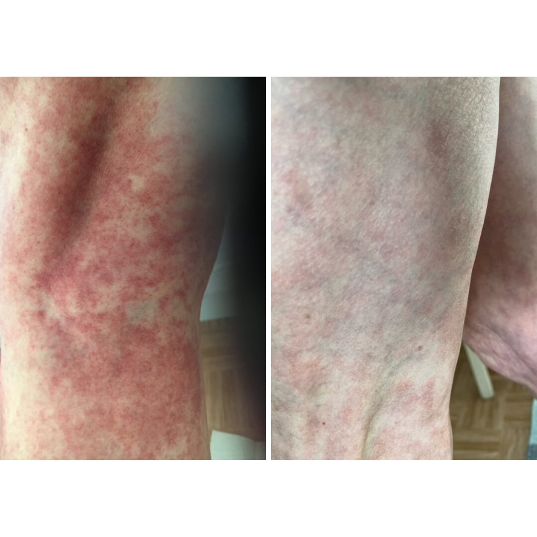 Talvisin sääreni hilseilevät ja yleensä vuodenvaihteessa tulee kutinaa ja välillä ihan tulehtuneen tuntuista punoitusta. Koska seuraan facessa ja nyt myös sähköpostilla sivujanne, niin innostuin ostamaan suihkusaippuakseni Särkisalon Suolasaippuan. Nyt kuukauden päivät tätä käytettyäni pitää kiittää. Kutina ja punoitus ovat poissa. Ehkä hieman punoitusta löytyy, mutta tosi vähän.