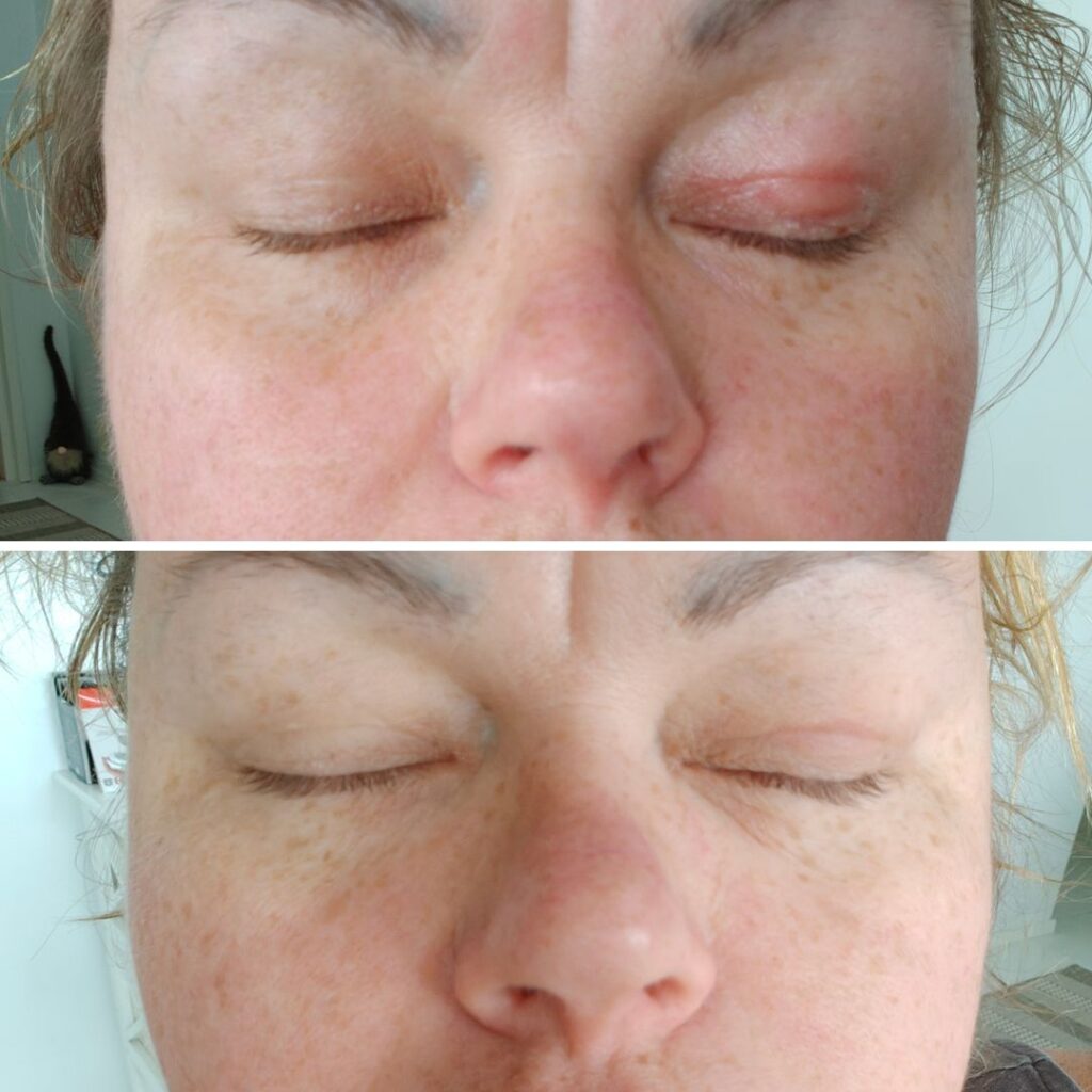 atooppinen ihottuma päivässä paremmaksi saaren taika kamomilla sheavoiteen avulla