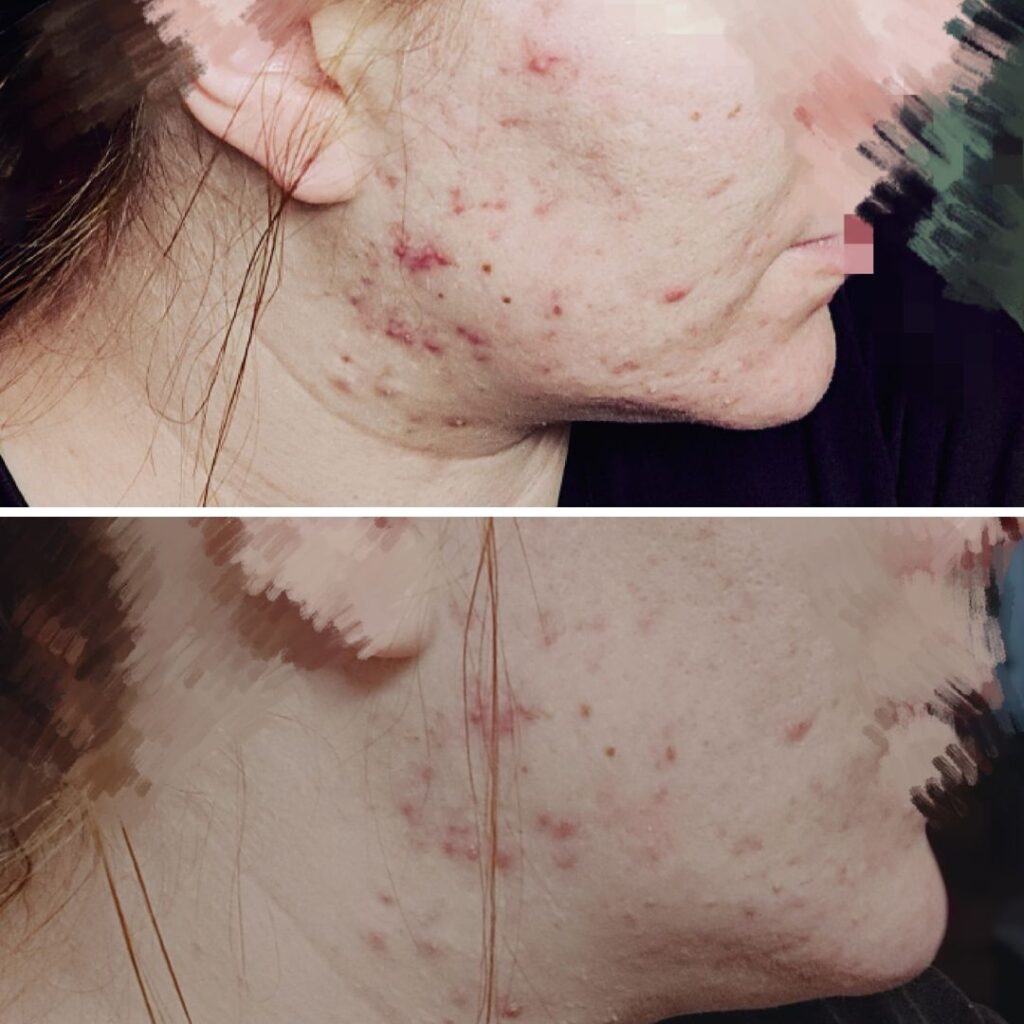 Käytössä siis Saaren Taika Teepuusaippua. Hyalyronihappoa sisältävä kasvo- ja silmänymoärysvoide on harkinnassa ostaa. Kasvoni ovan pintakuivat ja ihoni on herkkä. Mikään muu pesuaine ei ole toiminut omalle iholle. Itsellä erittäin paha hormonaalinen akne, jolloin aina ovulaation ja kuukautisten aikaan on pahoja kipeitä finnejä, osa ei edes puhkea, vaan jää todella pitkiksi ajoiksi kipuilemaan kasvoille. Etenkin leuan ja kaulan alueelle. Tässä kuvien oton välissä on kaksi päivää. Selkeästi on alkaneet laskemaan ja punoitus rauhoittunut. Todella tyytyväinen ja iloinen, kun toimivuus on näin hyvä. Kiitos teille.