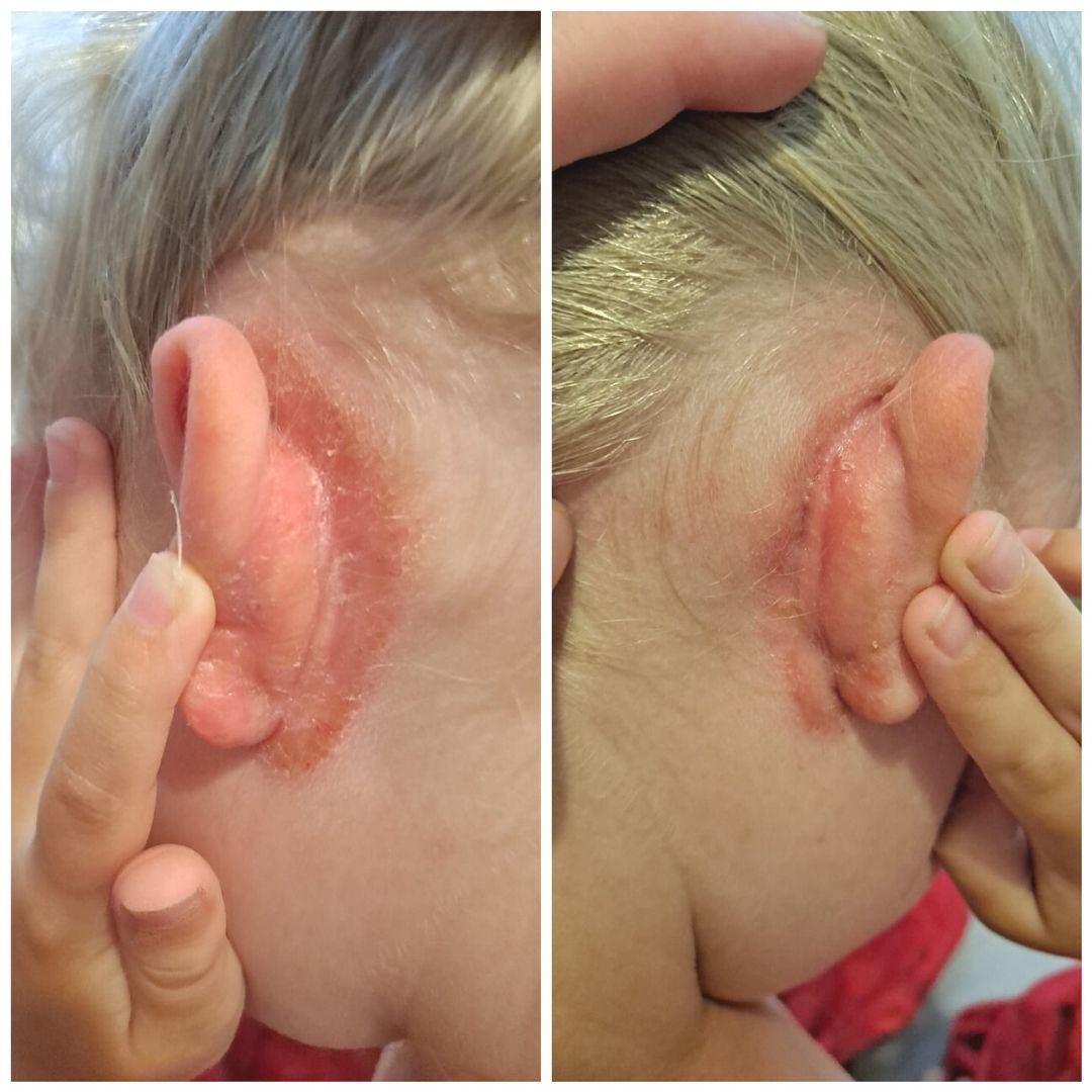 7v atoopikon korvantaustat on saatu vihdoin pysymään kunnossa, kiitos teidän kamomilla sheavoiteelle! Tässä kuvassa ei ole edes pahimmillaan... Kortisonikuureilla ihon sai siistiksi, mutta nopeesti kuurin loputtua paheni taas.