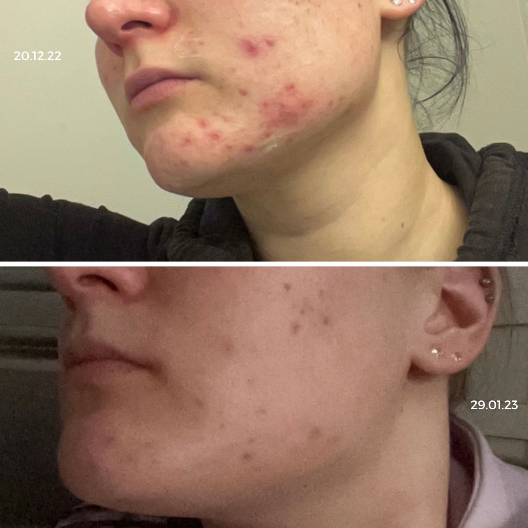 leuan akne lähti teepuusaippualla ja spot control voiteella