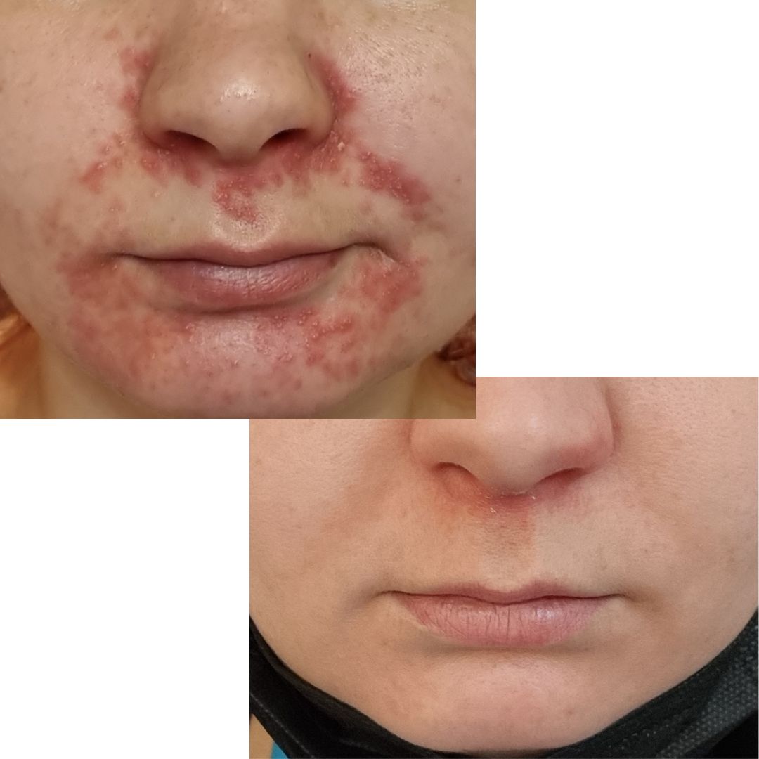 Hei! Olen kärsinyt suunympärysihottumasta n.7 vuotta. Aika ajoin jokin aiheuttaa tulehduksen ja naama hohtaa punaisena. Kuulin teidän teepuusaippuasta kaverilta ja päätin kokeilla. Ensin saippua ei tuntunut auttavan, mutta kun jaksoin jatkaa käyttöä, tulehdus hellitti ja pikkuhiljaa paraneminen alkoi. Empä taida uskaltaa olla käyttämättä enään! Tässä ennen ja jälkeen kuvat: Ennen 3.7. ja jälkeen 20.8.