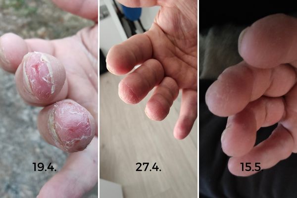 Kolme kuvaa ennen ja jälkeen, kun sormeinpäisät on nahak lähtenyt vereslihalle ja sitten ne parani, kun käytti Saaren Taika Kamomilla Sheavoidetta