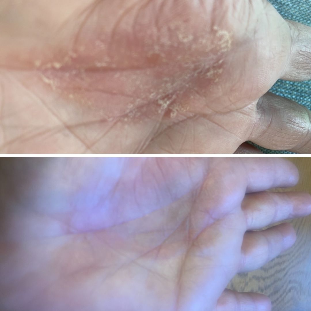 Olen huhtikuusta saakka kärsinyt oudosta ihottumasta kämmenissä sekä sormissa, joissa iho ns. kuoriutuu pois ja kutisee.Käynyt ihotautilääkärillä jossa ihottumaa tutkittu ja hoidettu erilaisin voitein, tuloksetta.Suomeen lomalle saapuessani päätin tilata Kamomilla Sheavoidetta, siitä pelkästään positiivisia kokemuksia lukeneena. Olen nyt käyttänyt voidetta kaksi viikkoa ja tämä outo ihottuma on rauhoittunut huomattavasti sekä tehnyt yllättävän käänteen, iho ei kuoriudu pois.