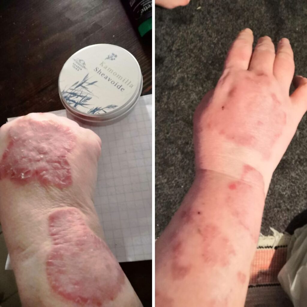 Hei! Aikuisella tyttärelläni on tosi paha Psoriasis. Tilasin hänelle kamomilla Sheavoiteen, jota käyttänyt. Veera Suolasaippua ollut myös käytössä. Ennen käyttöä oleva kuva otettu helmikuussa. Käytön jälkeen kuva nyt maaliskuussa. Läikät ovat vaalentuneet ja mikä parasta iho ei kiristä vaan joustaa ja kutina vähentynyt selkeästi. Tyttäreni sanoi, että tämä voide meni heittämällä jatkoon!
