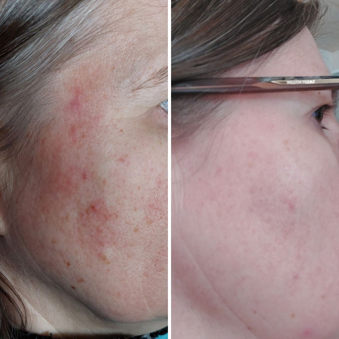 Moi. Liitteenä kuvat ennen ja jälkeen tuotteidenne käytön. Tyrni Luksus Spa saippua ja Rauhoittava Hoitovoide todella toimivat, kiitos siitä!