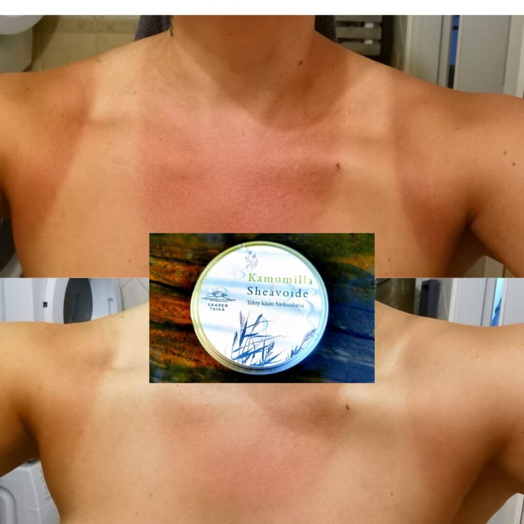 Työpaikkani kesäaikaan on ulkona veden äärellä ja väriä tulee pintaan urakalla. Näillä helteillä 9 tuntia +32 asteessa suorassa auringonpaisteessa saa tälläisen tummempihipiäisenkin polttamaan ihonsa! Illalla laitoin palaneille alueille Saaren Taian ihmettä, Kamomilla-Sheavoidetta ja kuva puhukoon puolestaan; aamulla iho oli liki normaali eikä yhtään arka! Tää voide on mulla aina mukana niin rinkassa kun töissä!