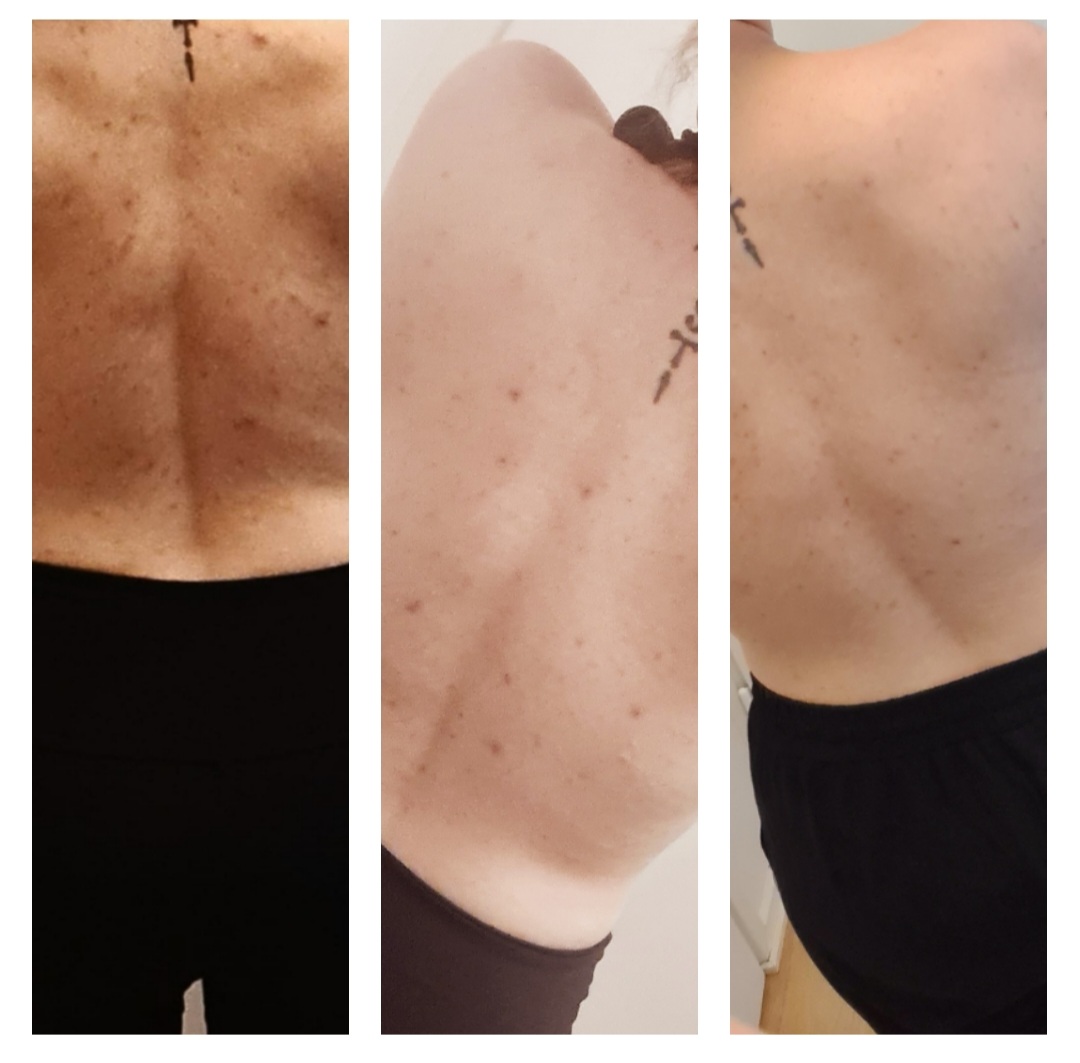 Oon 32 vuotias ja yli 15 vuotta kärsinyt ihon ongelmista. Oon syönyt ihotautilääkärin määräämiä erilaisia lääkekuureja jotka kuormittaa maksaa ja siihen päälle ovat vielä kalliita. Erityisesti selässä oli suuria ihonalaisia pesäkkeitä, jotka olivat todella kipeitä eikä mistään lääkkeestä ole niihin apua saanut. Nyt oon pessyt erityisesti selkää teidän teepuusaippualla 1,5kk ja selän ihonalaiset pesäkkeet on kadonnut ja ihon kunto muutenkin kohentunut. Olin aluksi todella skeptinen tulevana sairaanhoitajana, että jos lääketiede ei pysty kehittämään tuotetta joka auttaisi niin miten joku teepuu voisi mun elämää muuttaa. No tässä sitä ollaan, kohta alkaa teepuusaippua olla lopussa ja uuden tilaaminen edessä. Liitteenä olevassa kuvassa vasemmalla se mistä lähdettiin, ihonalaiset paukurat ei kunnolla näy, keskimmäinen muutaman viikon käytön jälkeen ja oikeanpuolimmainen kuva on eiliseltä. Silminnähtävän muutoksen lisäksi, parasta on se että esim. rintsikoiden käyttäminen ei tuota kipua. Oon niin iloinen tästä muutoksesta, et halusin jakaa tämän myös teidän kanssanne! Kiitos huipputuotteesta ja hyvää kesää teille sinne.