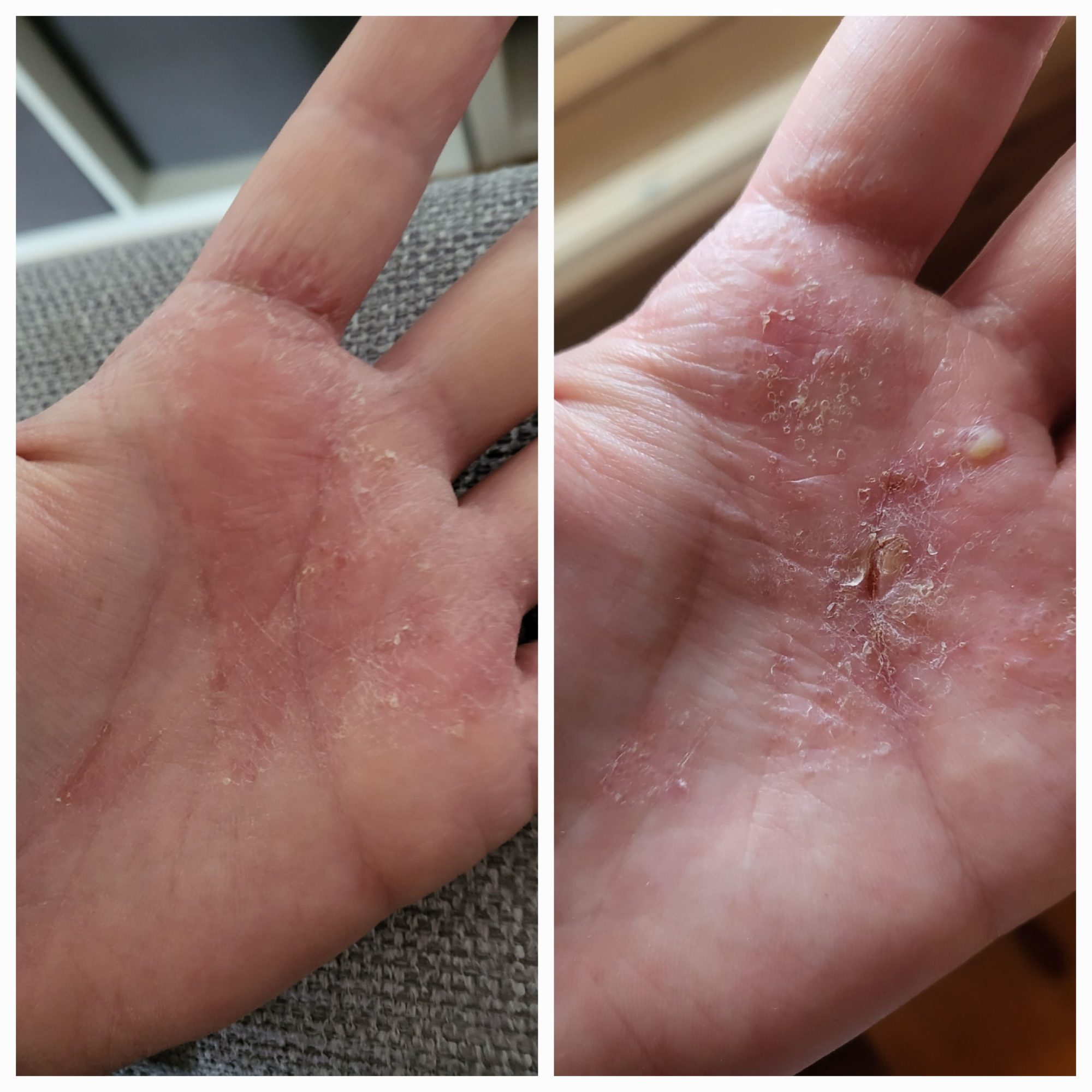 Veera suolasaippua. Viikon käyttö tuottanut tulosta käsi-ihottumalle.