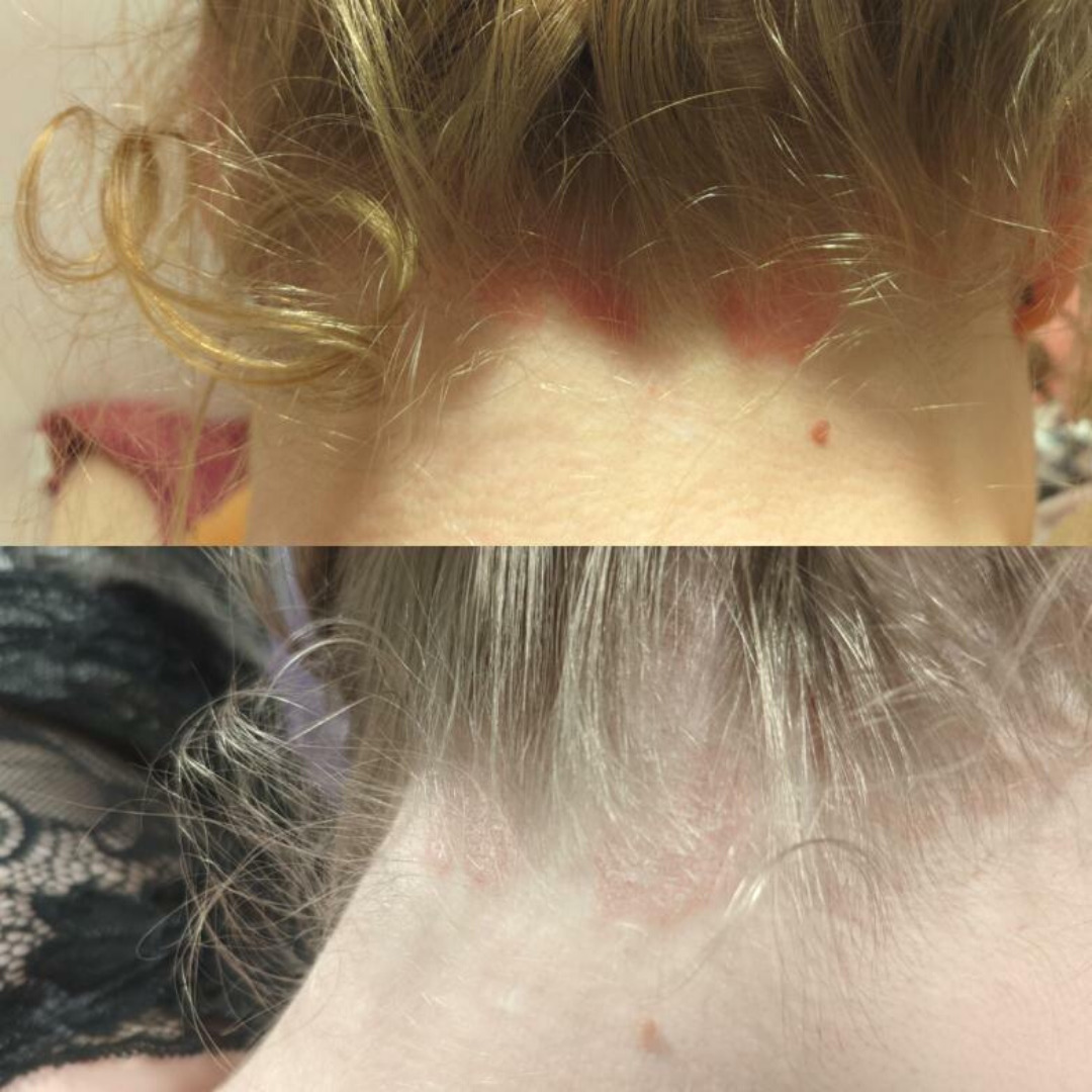 Halusin todella kiittää teidän vihreä tee & kamomilla shampoosta. Sairastan harvinaista sidekudosreumaa/SLE:tä (Lupus), sekä minulla on atooppinen iho. Joten iho-oireita löytyy paljon(osittain niitä häpeänkin). Olen kärsinyt päänahan/niskan alueen ihottumasta. Se on kutiavaa, punoittavaa ja kirveltää. Ihottuma reagoi hikoiluun ja säiden vaihteluun. Olen lätrännyt lapsesta saakka kortisoniliuoksilla sun muilla rasvoilla. Olen käyttänyt nyt teidän Vihreä tee & Kamomilla shampoota kaksi päivää ja ero on huomattava! Ihottuma on melkein pois. Plussana hiukset eivät edes rasvoitu samaan malliin. Ne ovat kiiltävät ja vahvemman oloiset. Kiitos vielä!