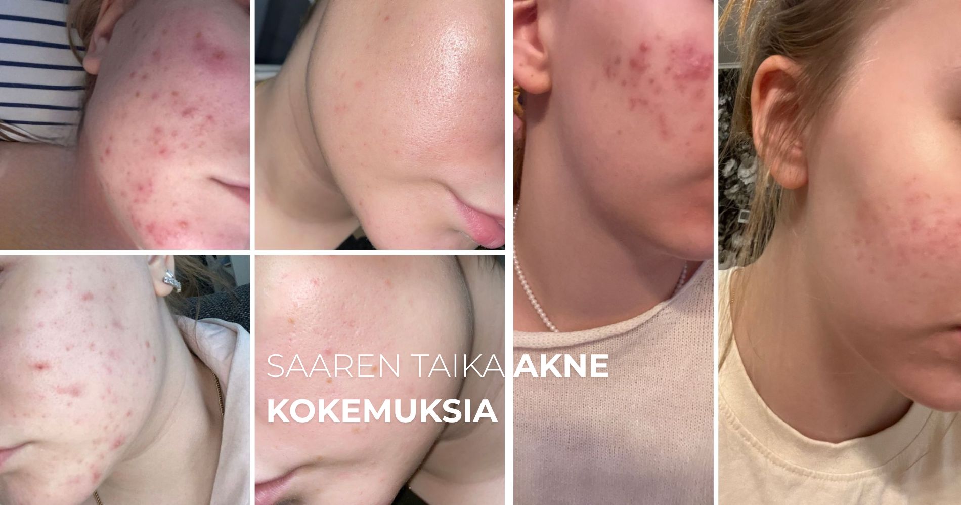 Saaren Taika akne kokemuksia